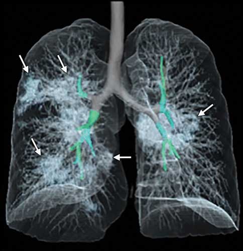 Coronavirus induced damage to the lungs